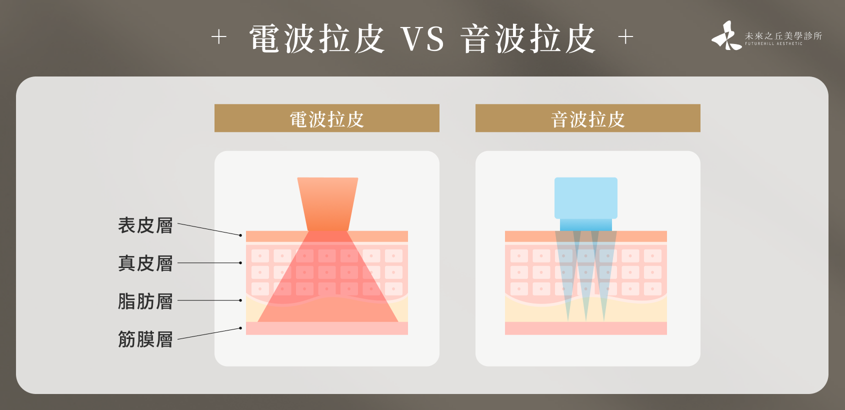 電波拉皮 VS 音波拉皮