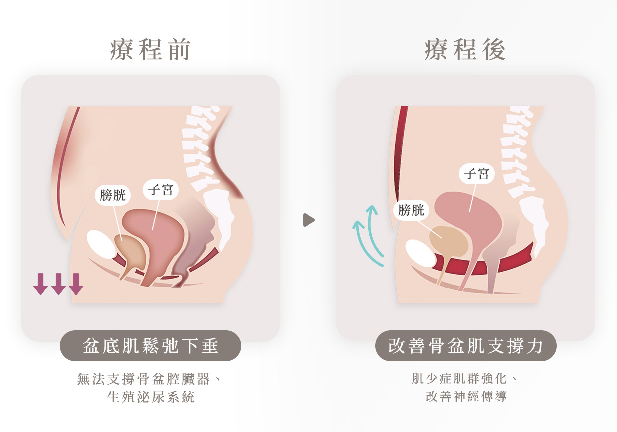 寵愛椅改善骨盆支撐力